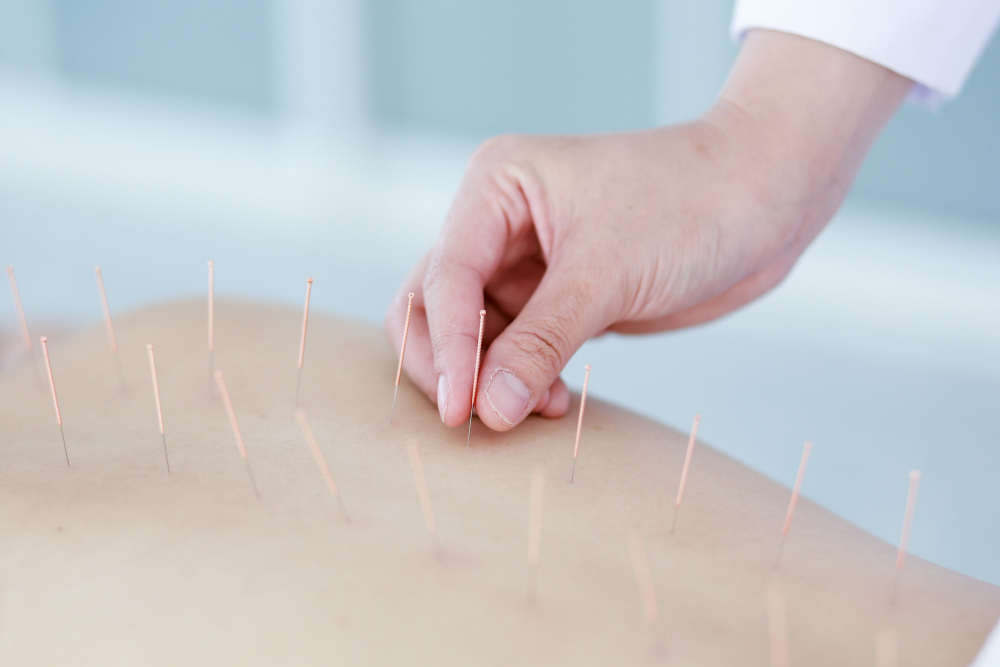Akupunktur Nasıl Etki Ediyor?